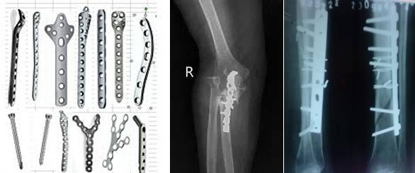 牙齿有金属填充物能不能做磁共振,做磁共振身上带金属会伤害身体吗