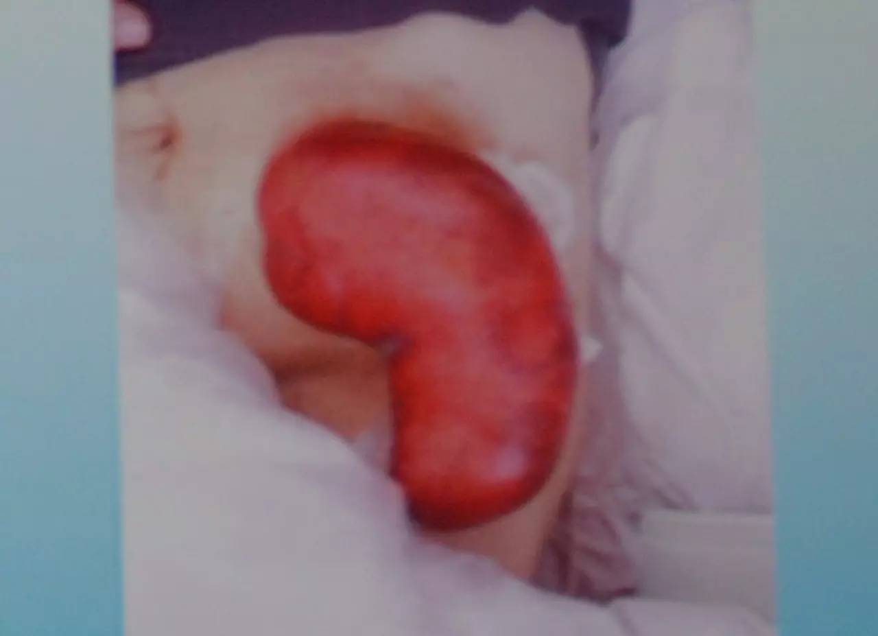 肠造口常见周围皮肤并发症,肠造口手术的并发症