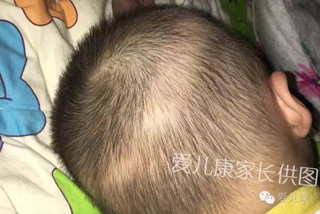 宝宝掉头发是奶粉问题吗,宝宝掉头发说说