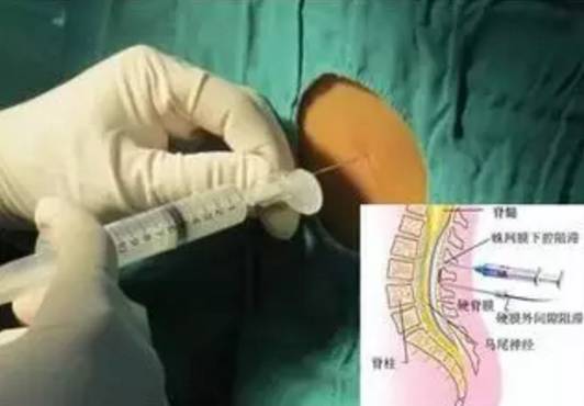 科普一刻|你真的了解顺产、剖腹产和无痛分娩吗?