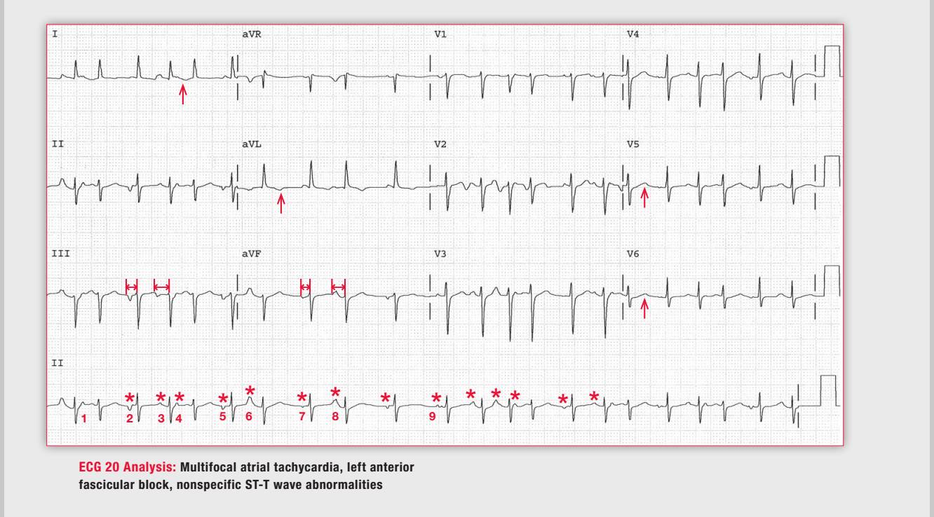 「读心有术」164期:这种多源性房速需要治疗吗?
