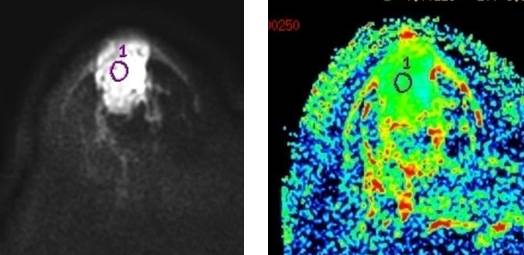 牙齿有金属填充物能不能做磁共振,做磁共振身上带金属会伤害身体吗