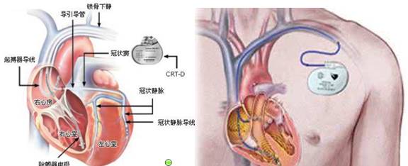 牙齿有金属填充物能不能做磁共振,做磁共振身上带金属会伤害身体吗