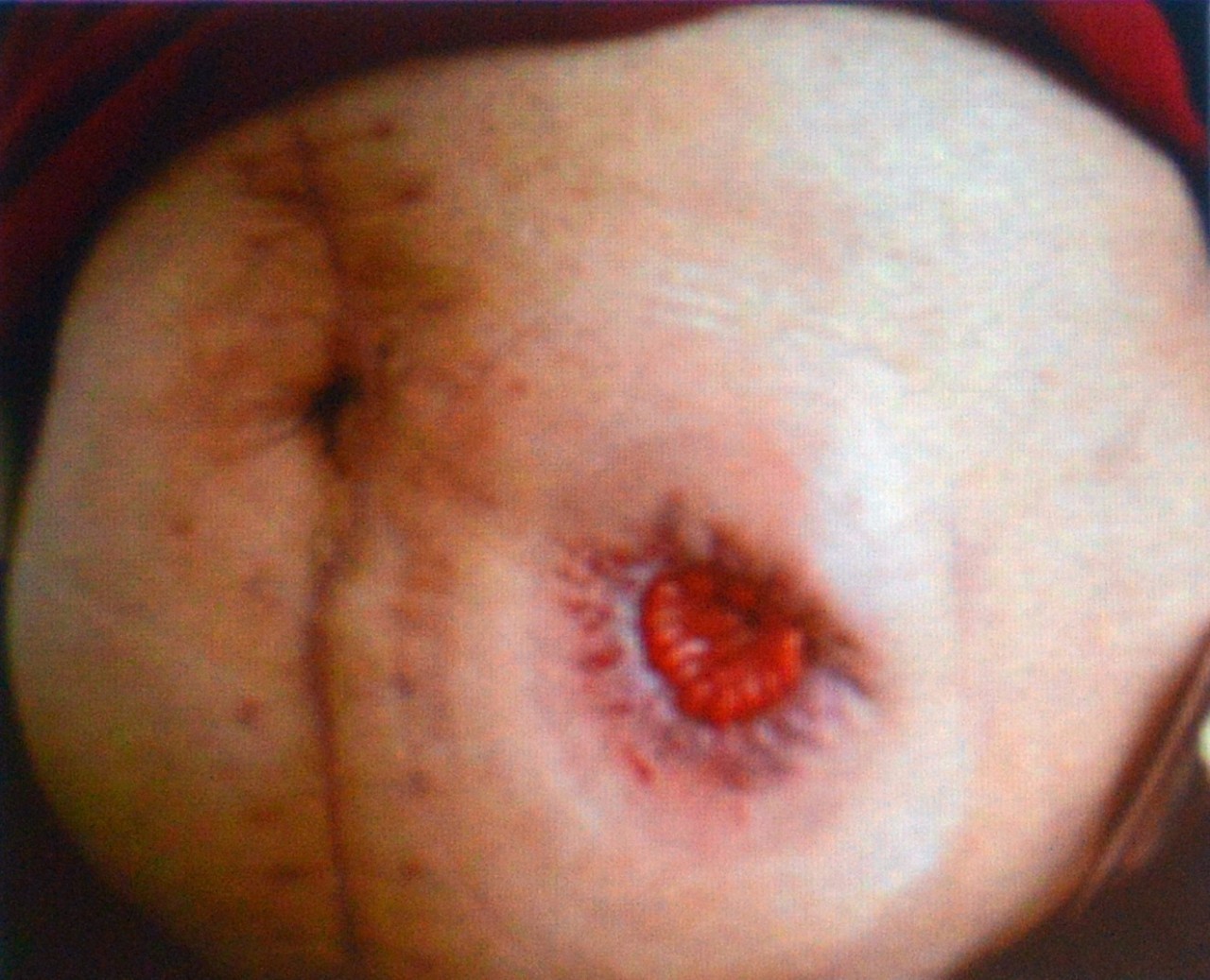 肠造口常见周围皮肤并发症,肠造口手术的并发症