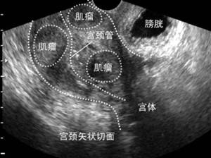 子宫肌瘤准妈妈,当孕妈妈遇上了子宫肌瘤