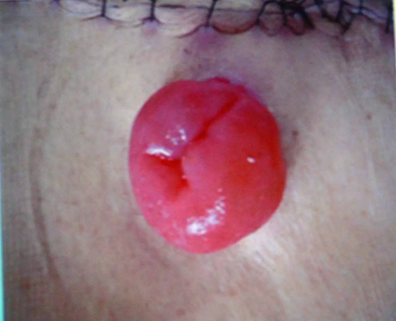 肠造口常见周围皮肤并发症,肠造口手术的并发症