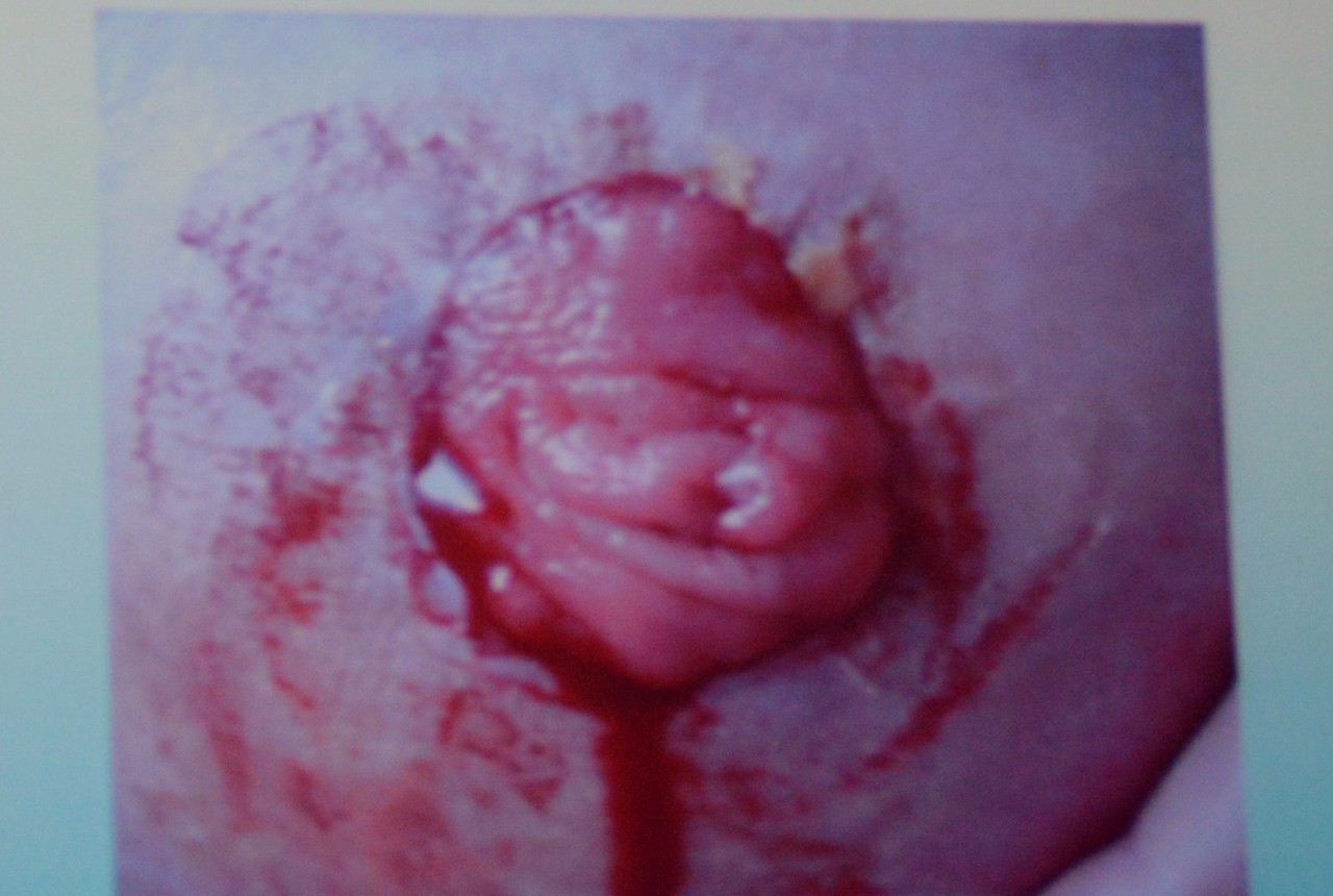 肠造口常见周围皮肤并发症,肠造口手术的并发症