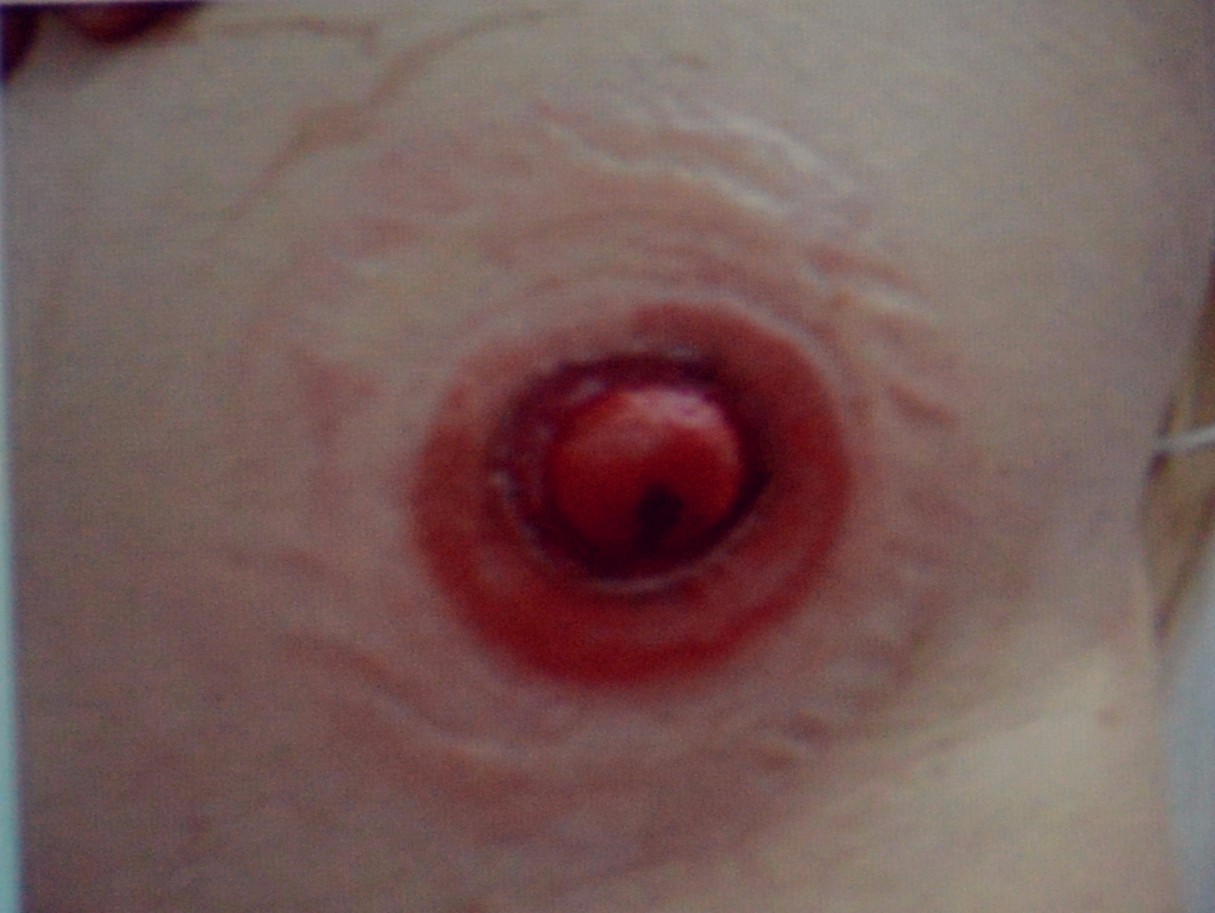 肠造口常见周围皮肤并发症,肠造口手术的并发症