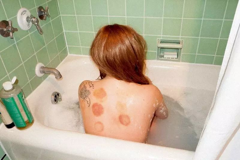 精品话题｜拔罐、针灸，你们的idol“好这口”！