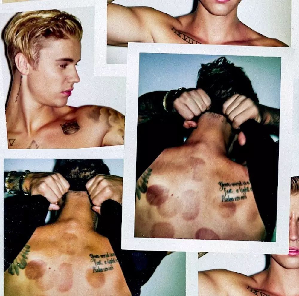 精品话题｜拔罐、针灸，你们的idol“好这口”！