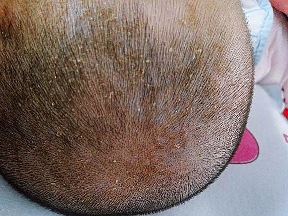 宝宝头皮有乳痂能剪头发吗,婴儿的头皮痂巧处理