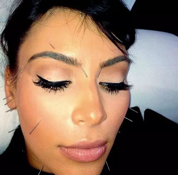 精品话题｜拔罐、针灸，你们的idol“好这口”！