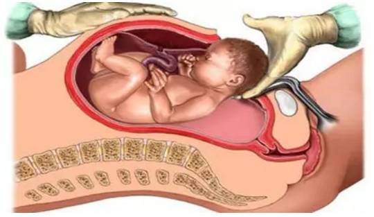 科普一刻|你真的了解顺产、剖腹产和无痛分娩吗?