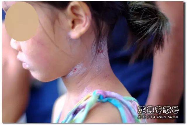 「热点」越是古老的疾病坑越多，一个湿疹能有多少坑把父母掉进去？