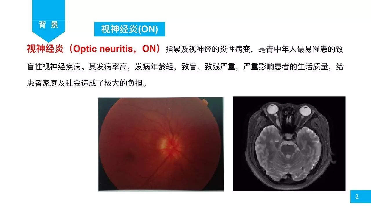 魏世辉视神经脊髓炎最新研究,301魏世辉治疗视神经萎缩