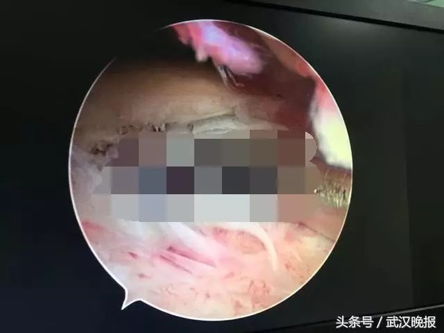 吓人!她肩膀居然破了个“洞”,只因天天做这个动作……黔南人赶紧自查看看!