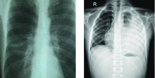 怀孕拍了x光片胎儿一定不能要吗,拍x光片10天后发现怀孕了怎么办