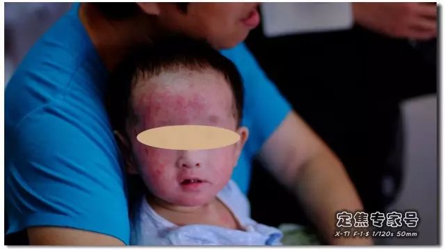 「热点」越是古老的疾病坑越多，一个湿疹能有多少坑把父母掉进去？