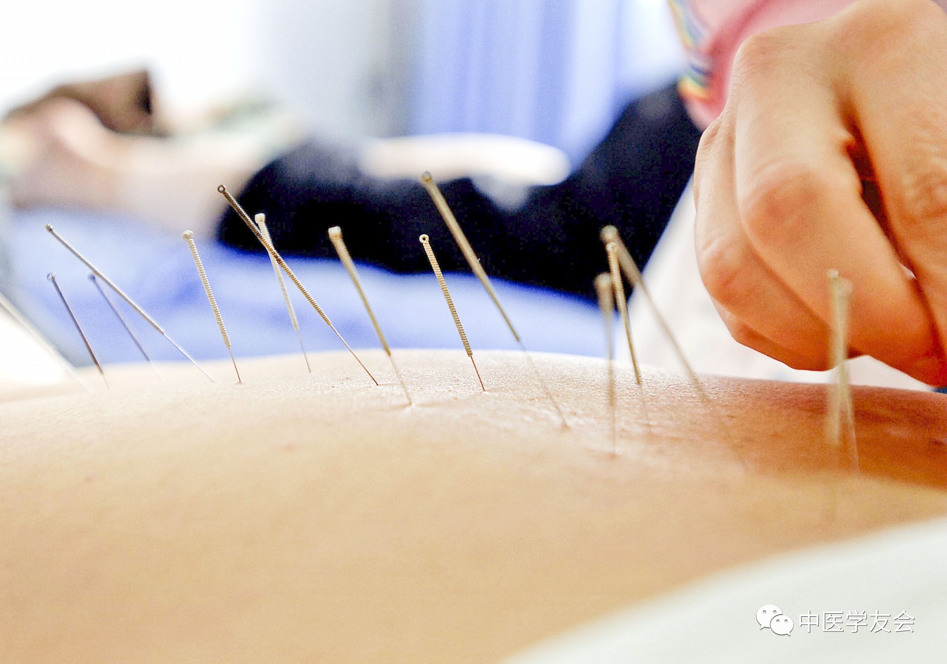 减肥不吃药不节食针灸减肥有神效