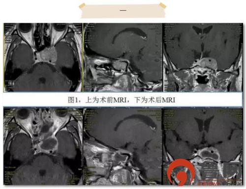 青岛齐鲁医院神经外科住院部,齐鲁医院青岛院区神经内科