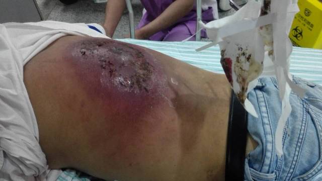 小疖子,有时可能也会要命!