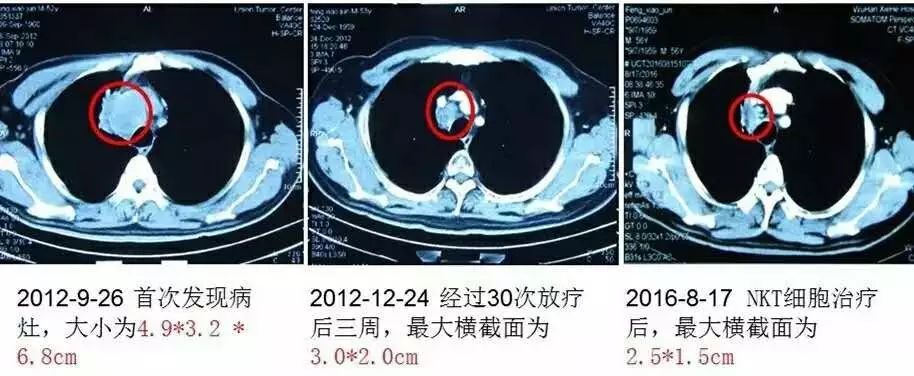肿瘤复发再治疗有效果吗,肿瘤康复的可能性