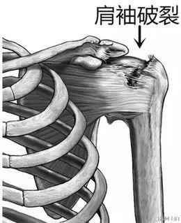 吓人!她肩膀居然破了个“洞”,只因天天做这个动作……黔南人赶紧自查看看!