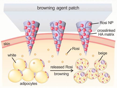 减肥贴的正确方式,减肥要贴什么穴位
