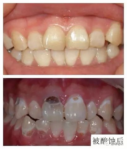 920爱牙日·牙齿酸软请心疼自己,80%的解决办法都在这里了,请自取