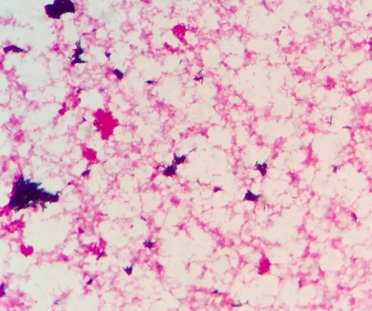 警惕！也许只是因为吃了一盘沙拉或生冷食物，浙江一名怀孕7个多月的产妇感染了……导致胎死腹中！
