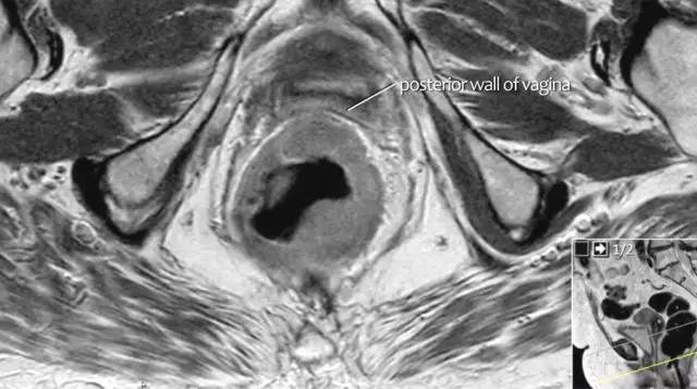 记住一个单词的一般方法,记住癌症九字诀