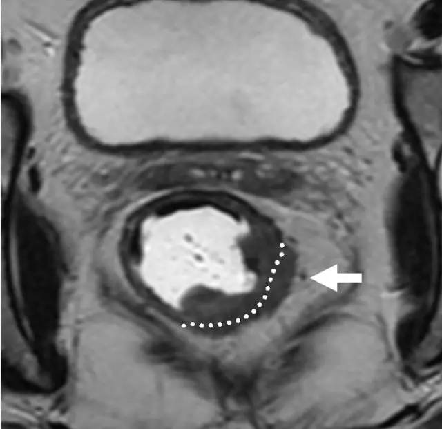 记住一个单词的一般方法,记住癌症九字诀