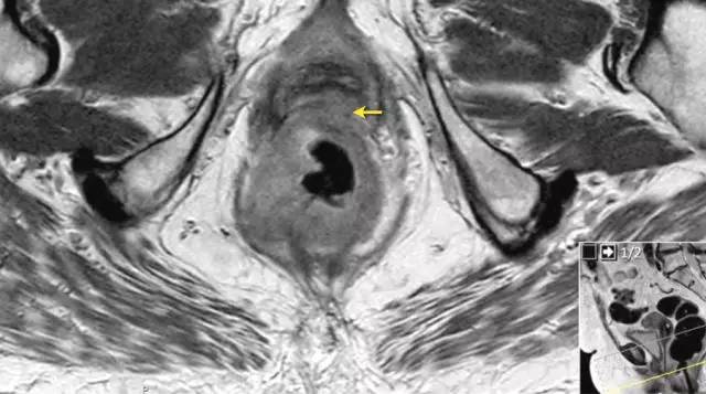 记住一个单词的一般方法,记住癌症九字诀