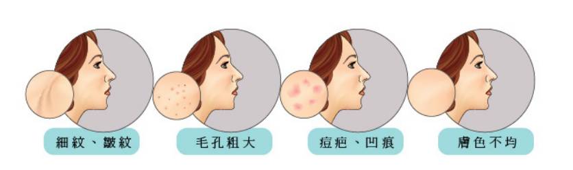 激光祛闭口痘痘,闭口粉刺可以做激光祛痘吗