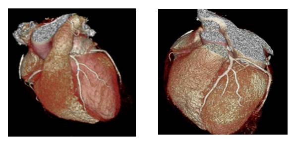 冠脉ct各个血管解读,冠脉CTA讲解