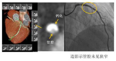 冠脉ct各个血管解读,冠脉CTA讲解