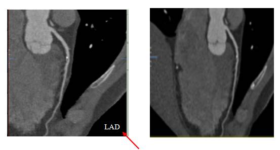 冠脉ct各个血管解读,冠脉CTA讲解