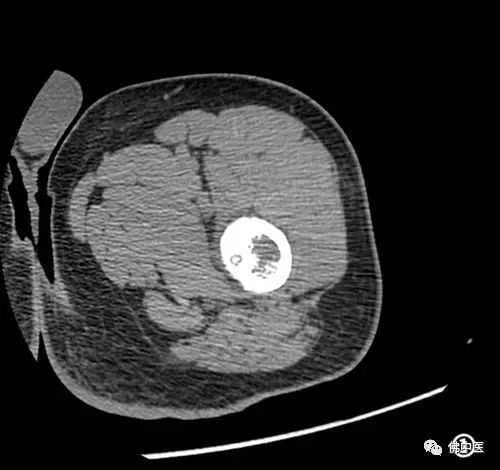 「高超」微创直达深巢，射频消融病灶，佛中医治疗骨样骨瘤有新招