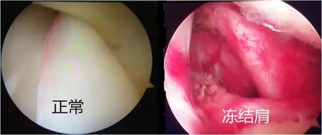 吓人!她肩膀居然破了个“洞”,只因天天做这个动作……黔南人赶紧自查看看!