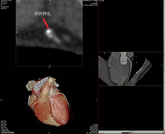 冠脉ct各个血管解读,冠脉CTA讲解