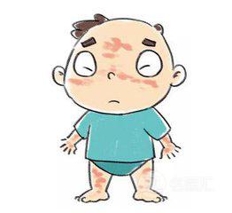 麻疹怎么治疗根除,麻疹怎么处理