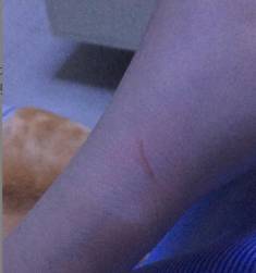 一般被狂犬咬伤狂犬病疫苗多少钱,被猫狗轻微抓伤需要打狂犬疫苗吗