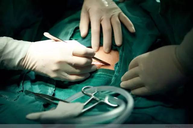 剖腹产全景记录,剖腹产恢复不同时期的照片