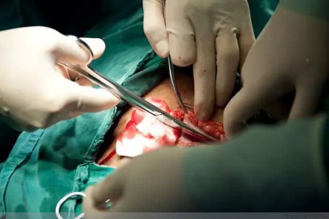 剖腹产全景记录,剖腹产恢复不同时期的照片