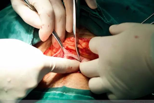 剖腹产全景记录,剖腹产恢复不同时期的照片