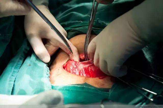 剖腹产全景记录,剖腹产恢复不同时期的照片