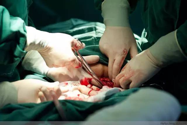 剖腹产全景记录,剖腹产恢复不同时期的照片