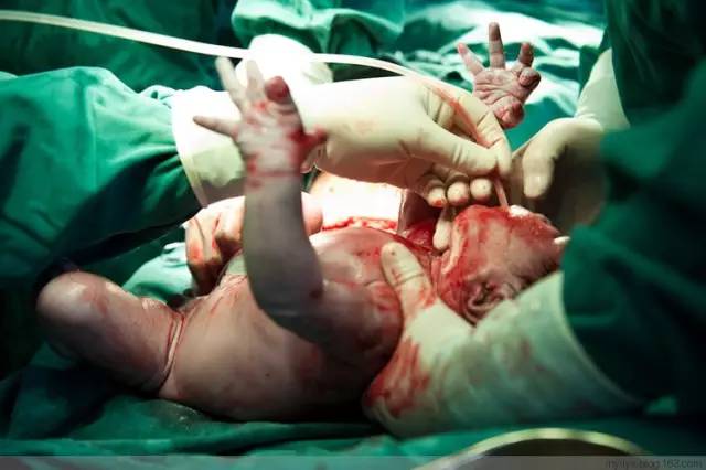 剖腹产全景记录,剖腹产恢复不同时期的照片