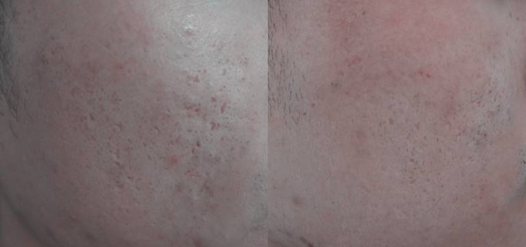 激光祛闭口痘痘,闭口粉刺可以做激光祛痘吗