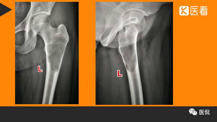 髋部疼痛做什么检查,左髋部疼痛待查病例